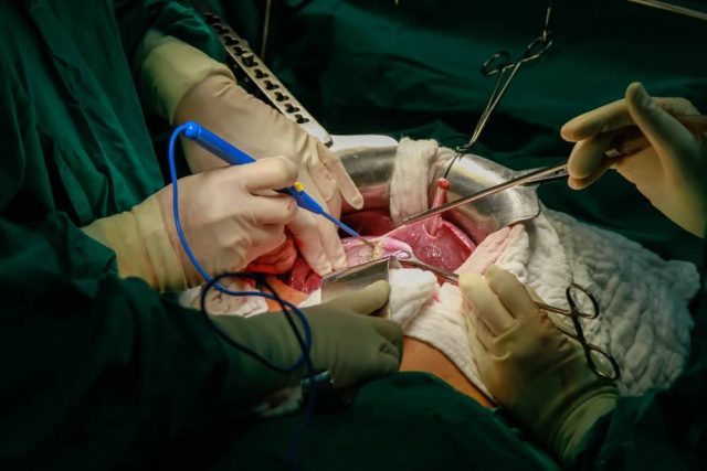 transplantacija organa
